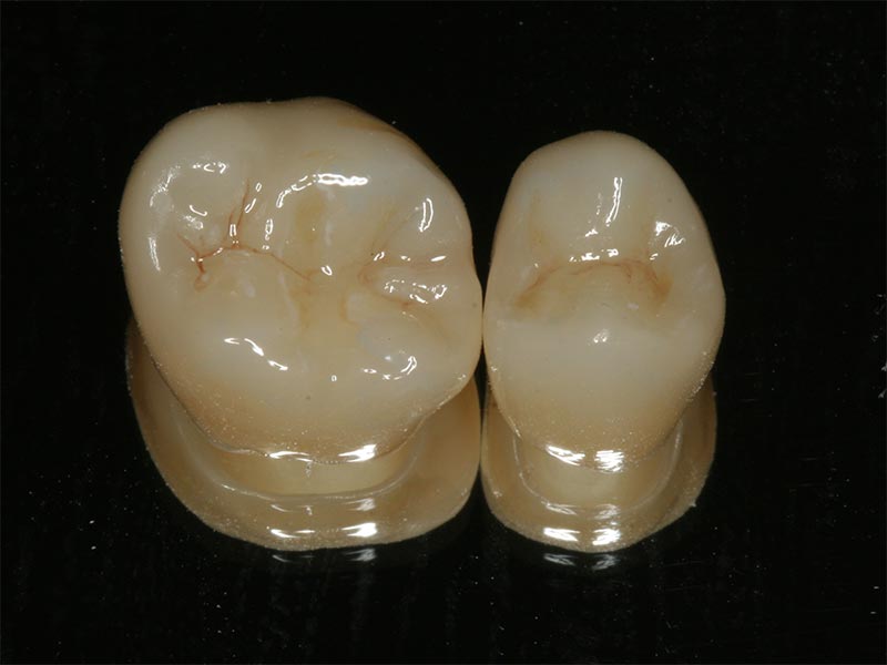 Vollkeramischer Zahnersatz