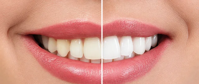 Zahnfarbe vor und nach dem Bleaching im Vergleich