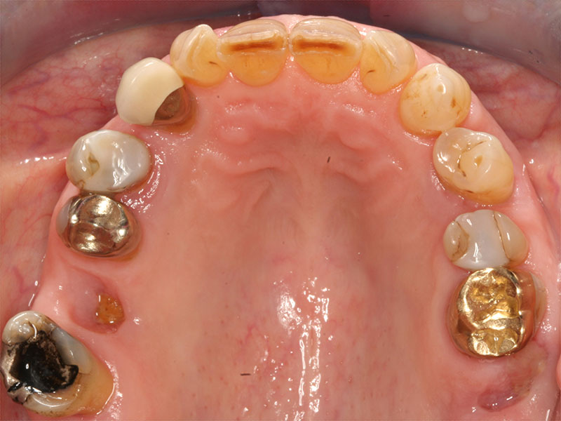 Brücke CEREC Methode