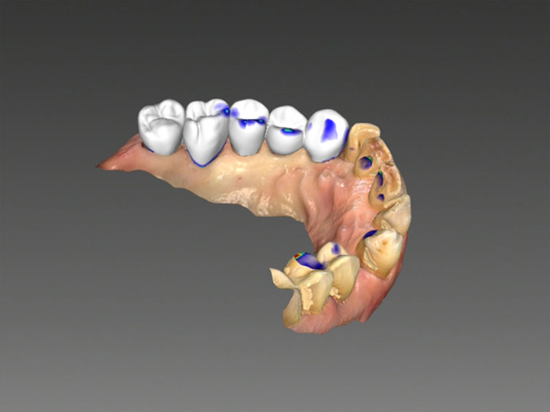 Brücke CEREC Methode