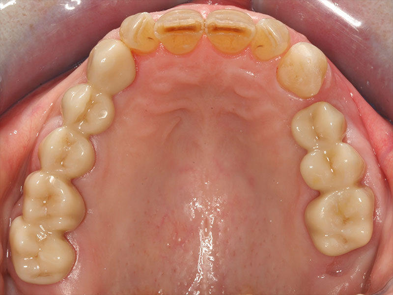 Brücke CEREC Methode