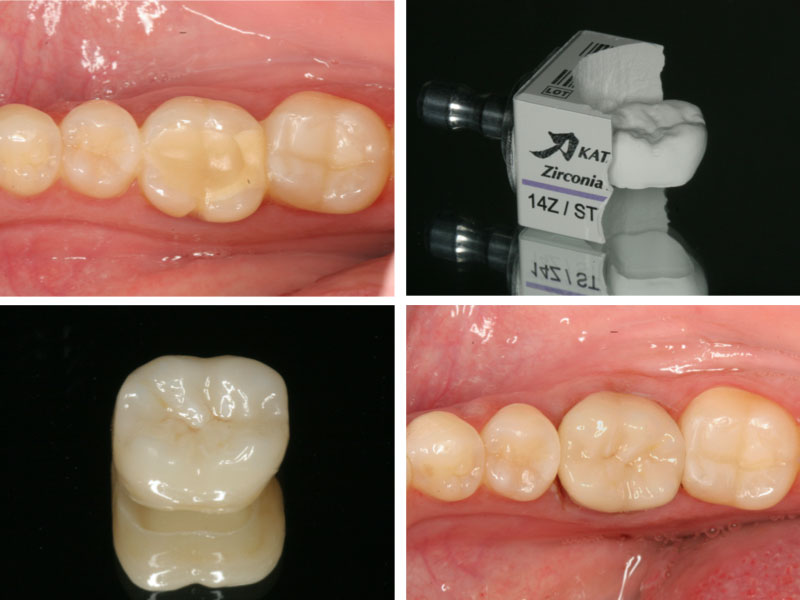 Einzelkrone CEREC Methode
