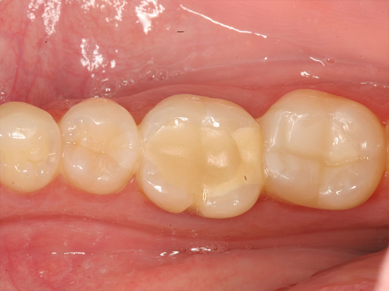 Einzelkrone CEREC Methode