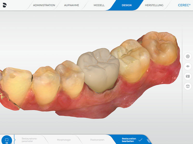 Einzelkrone CEREC Methode