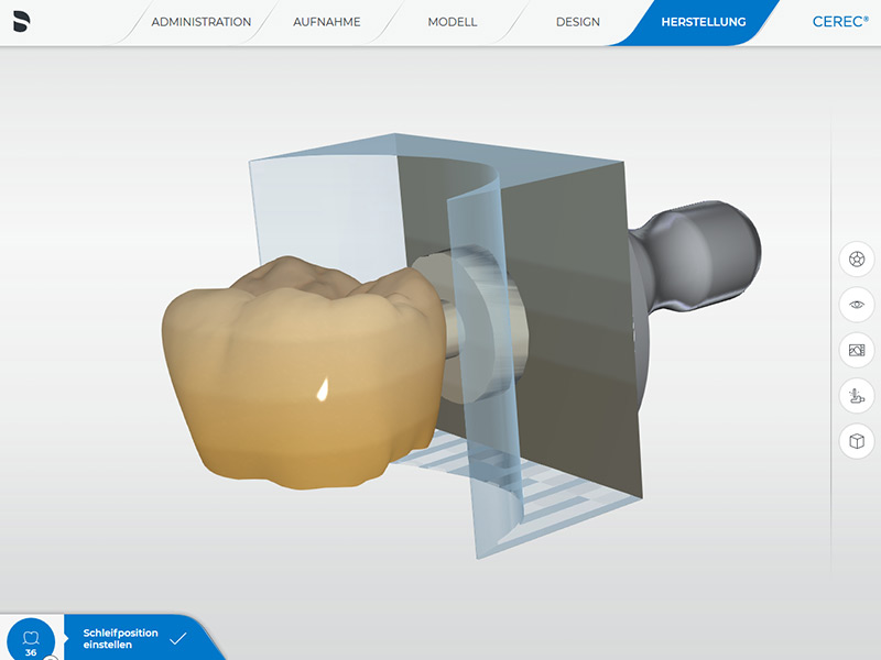 Einzelkrone CEREC Methode