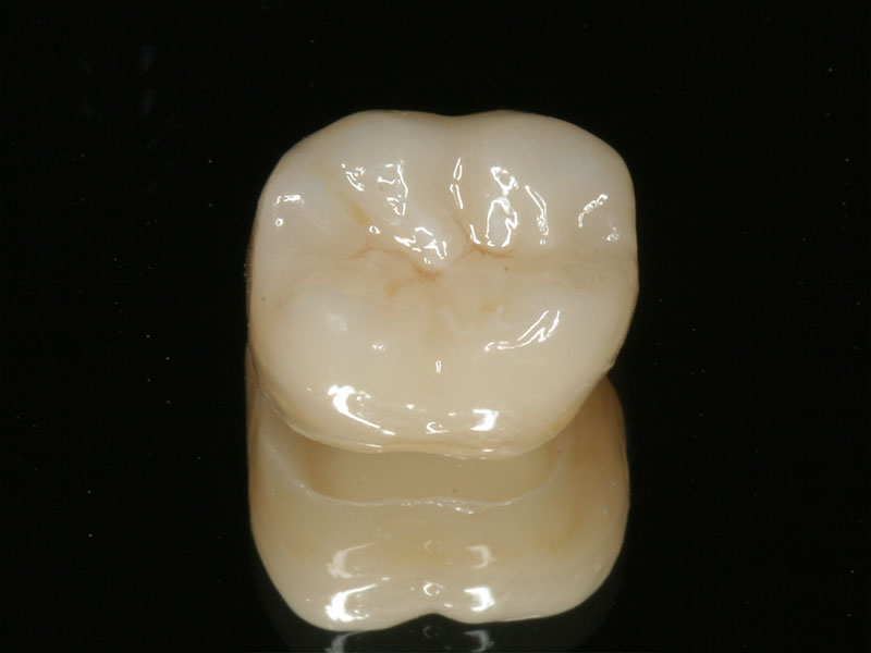 Einzelkrone CEREC Methode