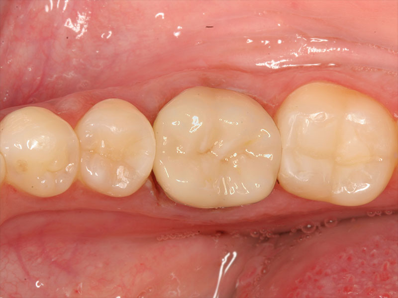 Einzelkrone CEREC Methode