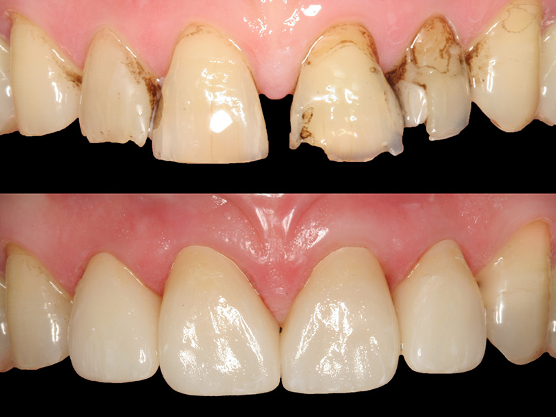 Frontzähne CEREC Methode