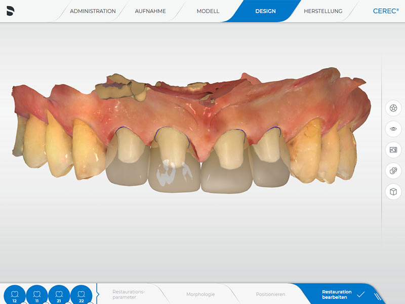 Frontzähne CEREC Methode