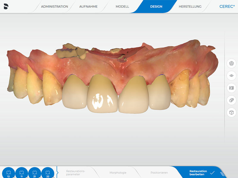 Frontzähne CEREC Methode
