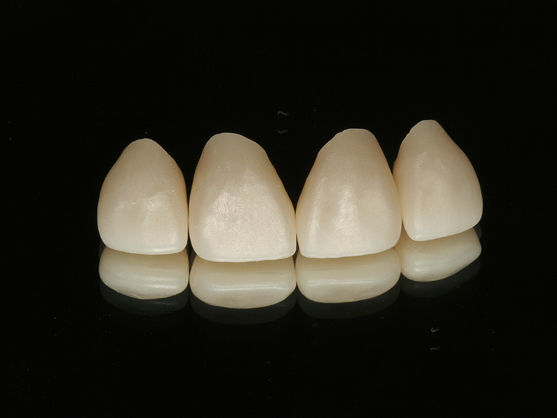 Frontzähne CEREC Methode