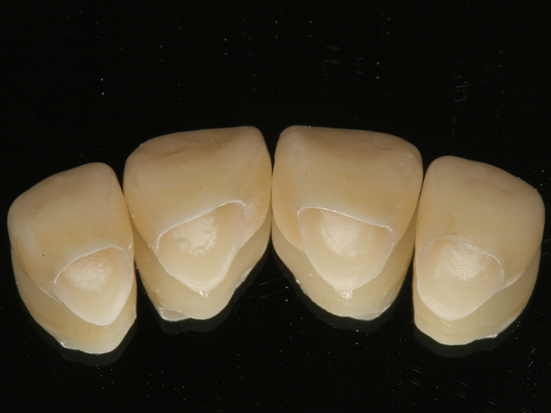 Frontzähne CEREC Methode