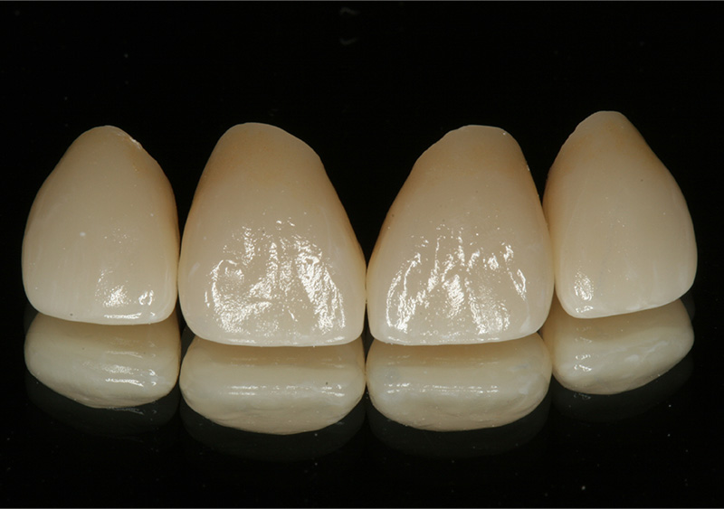 Frontzähne CEREC Methode