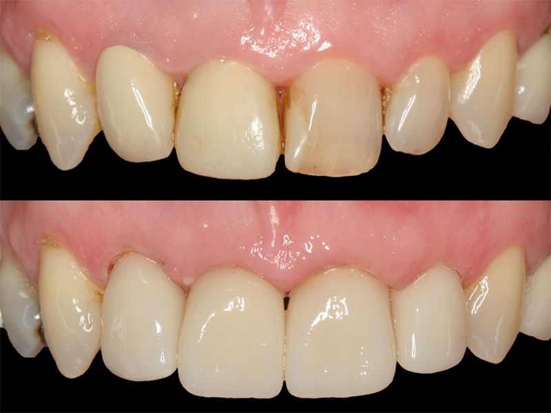 Frontzähne CEREC Methode