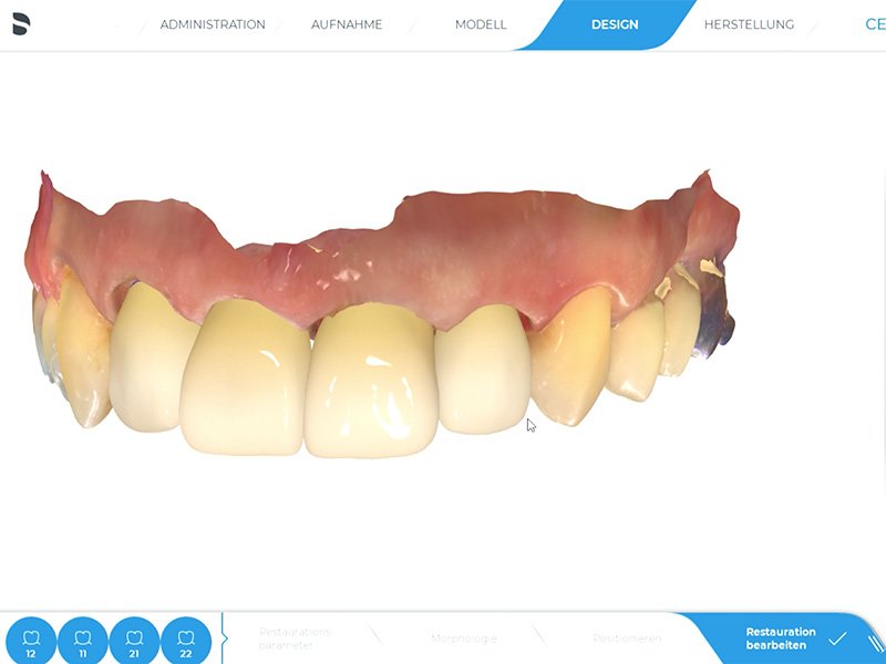 Frontzähne CEREC Methode