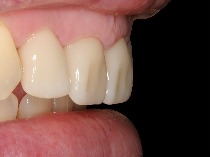 Frontzähne CEREC Methode