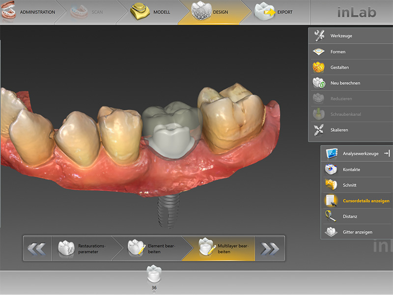 Implantatkrone CEREC Methode