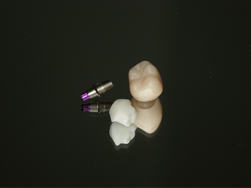 Implantatkrone CEREC Methode