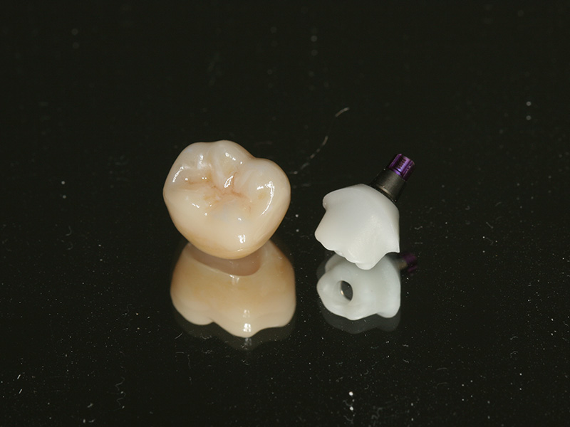 Implantatkrone CEREC Methode