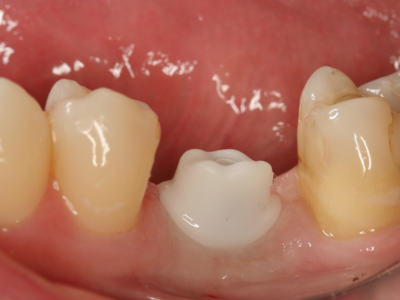 Implantatkrone CEREC Methode