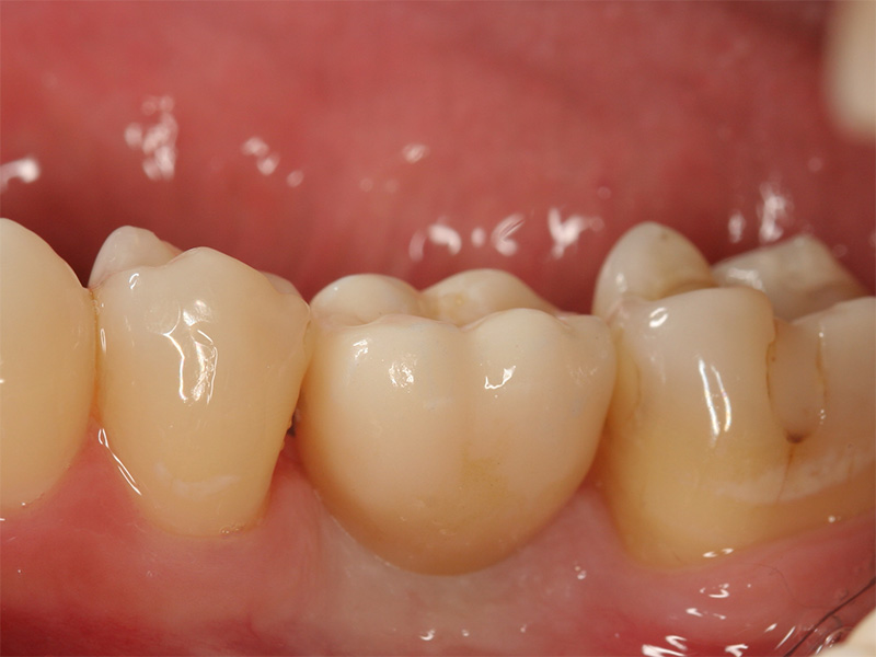 Implantatkrone CEREC Methode