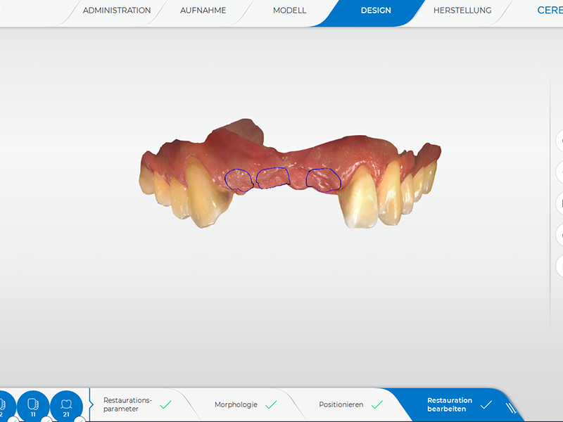 3D Planung Implantologie