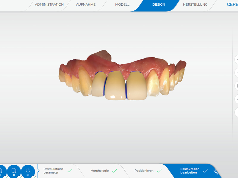 3D Planung Implantologie