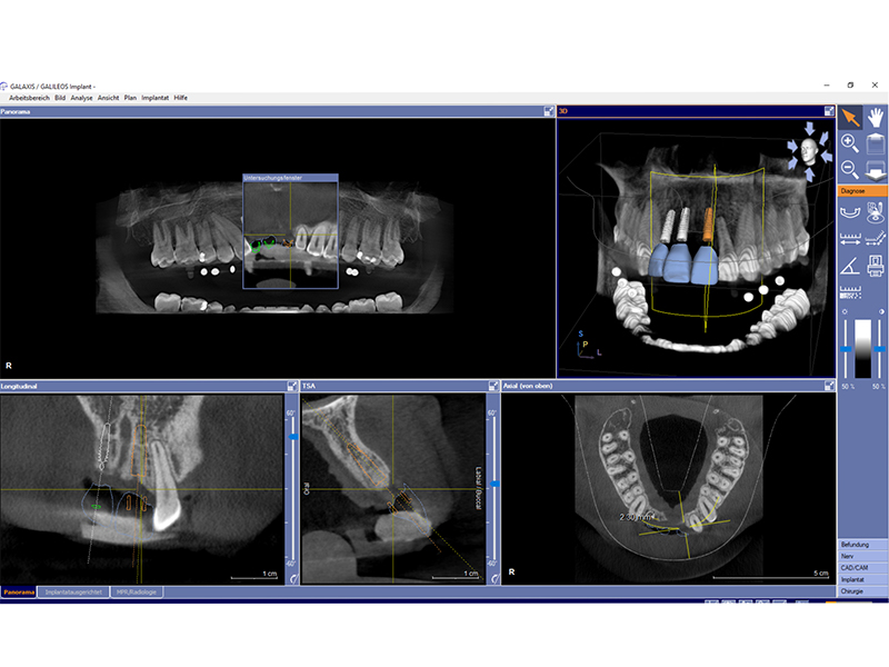 3D Planung Implantologie