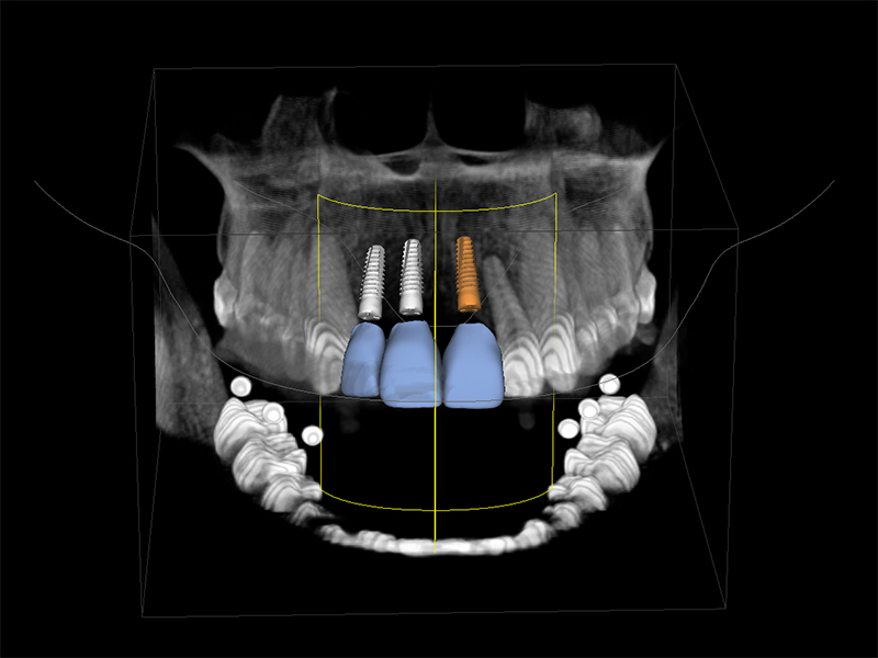 3D Planung Implantologie