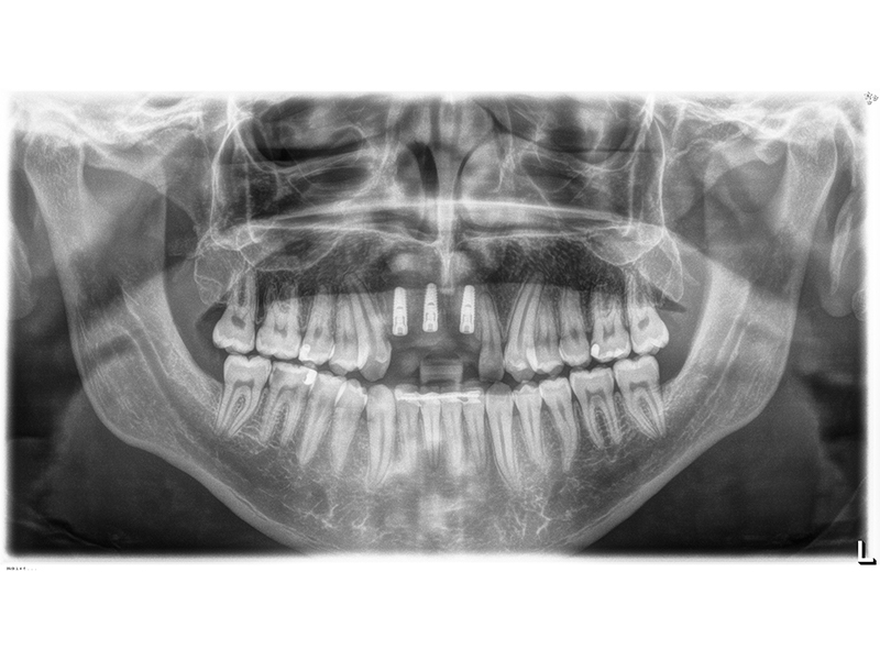 3D Planung Implantologie