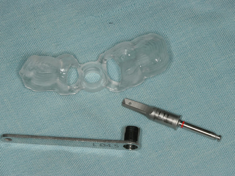 Bohrschablone Implantologie