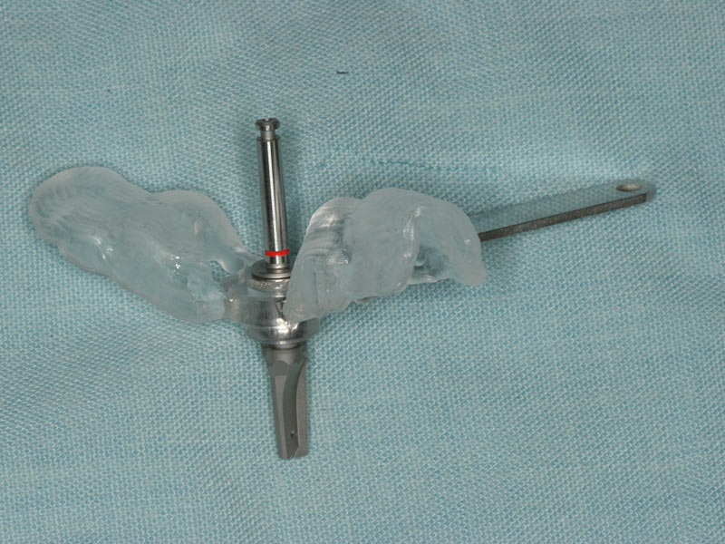 Bohrschablone Implantologie