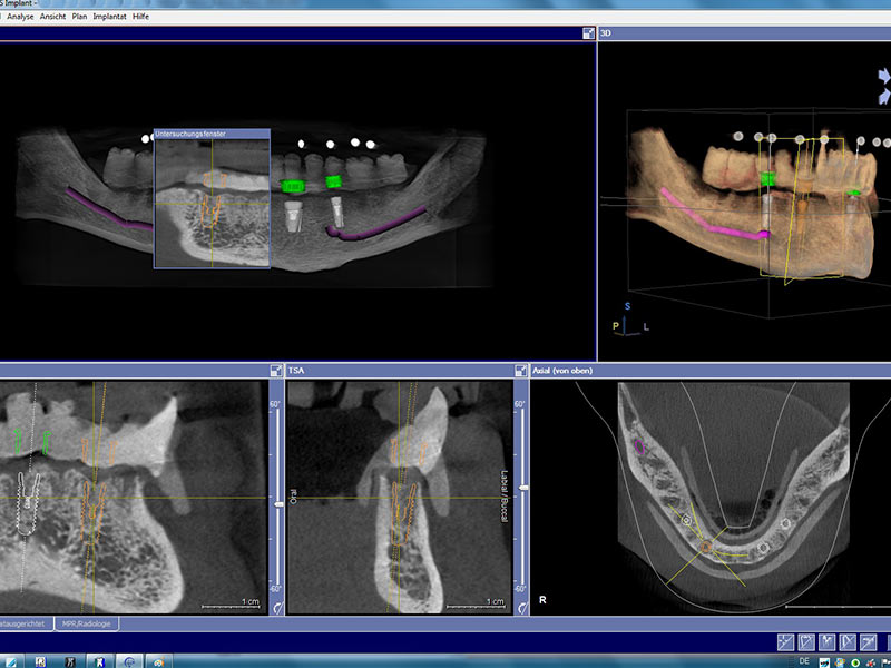 Implantation ohne Skalpell
