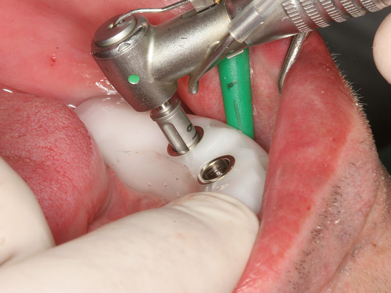 Implantation ohne Skalpell