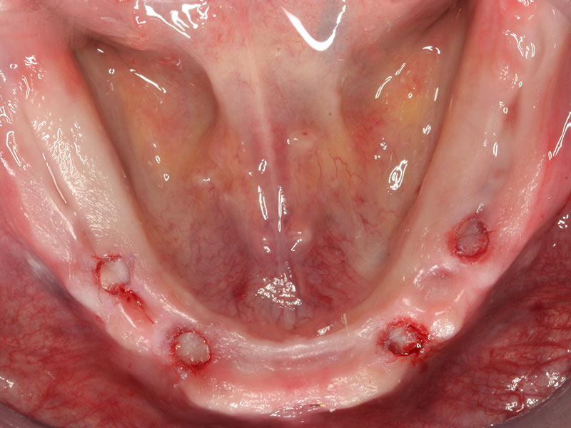 Implantation ohne Skalpell