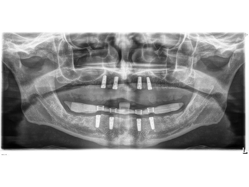 Implantation ohne Skalpell