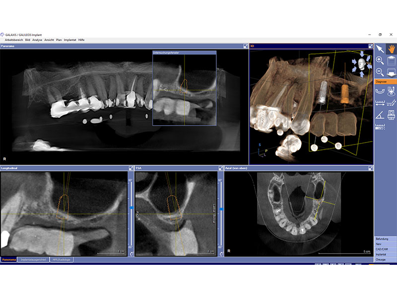 Knochenaufbau Implantologie