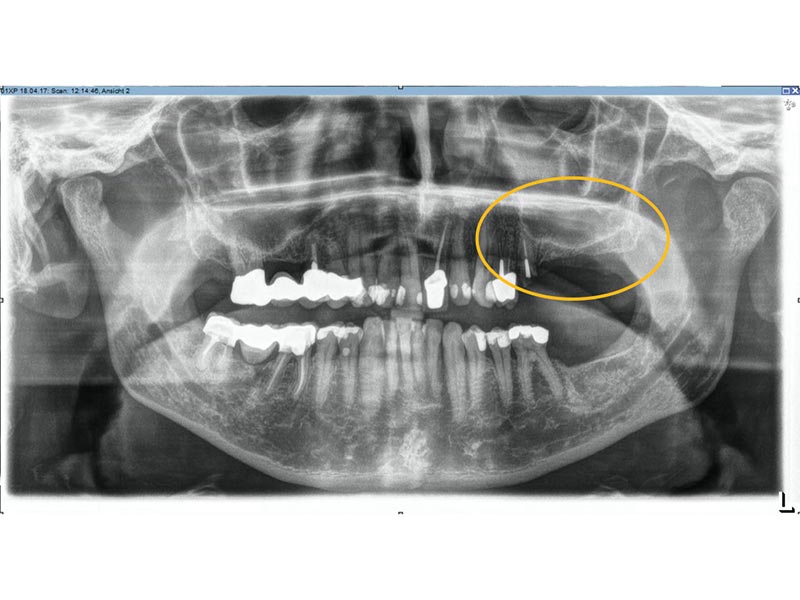 Knochenaufbau Implantologie