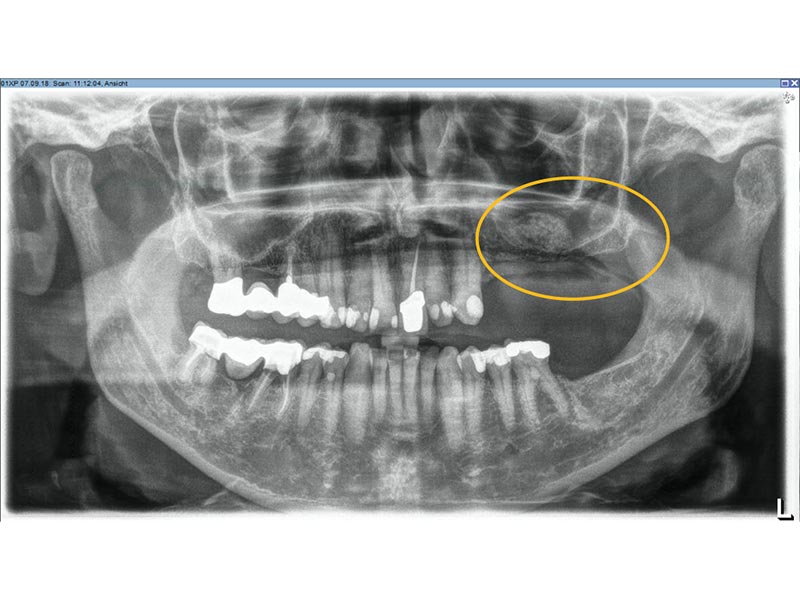 Knochenaufbau Implantologie