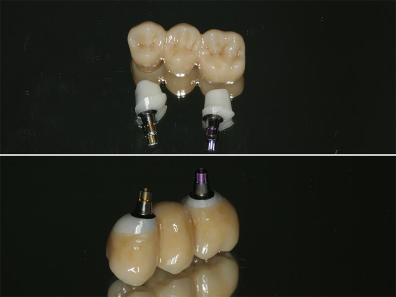 Knochenaufbau Implantologie