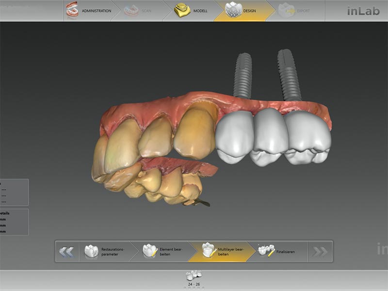 Knochenaufbau Implantologie