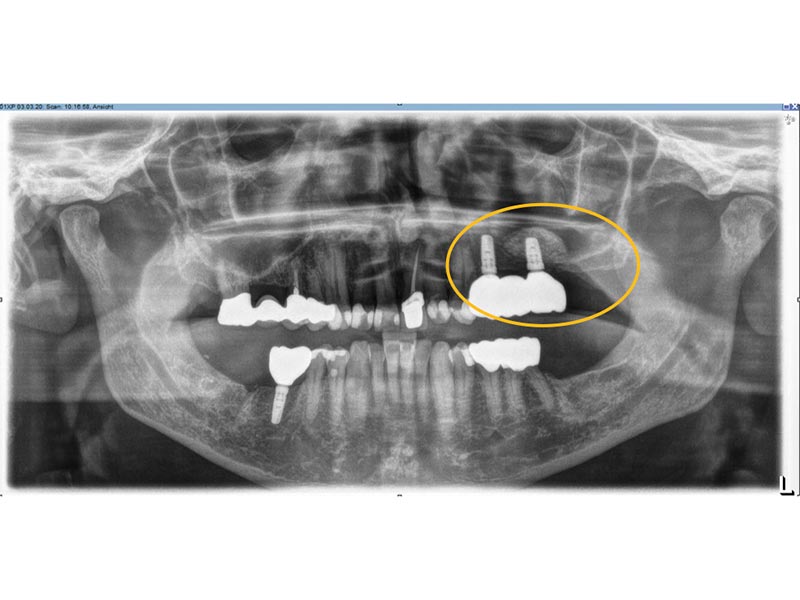 Knochenaufbau Implantologie