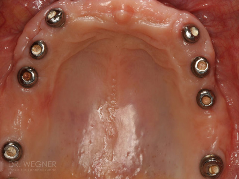 Komplexe Implantatbehandlung