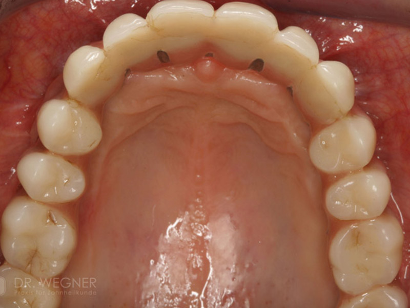 Komplexe Implantatbehandlung