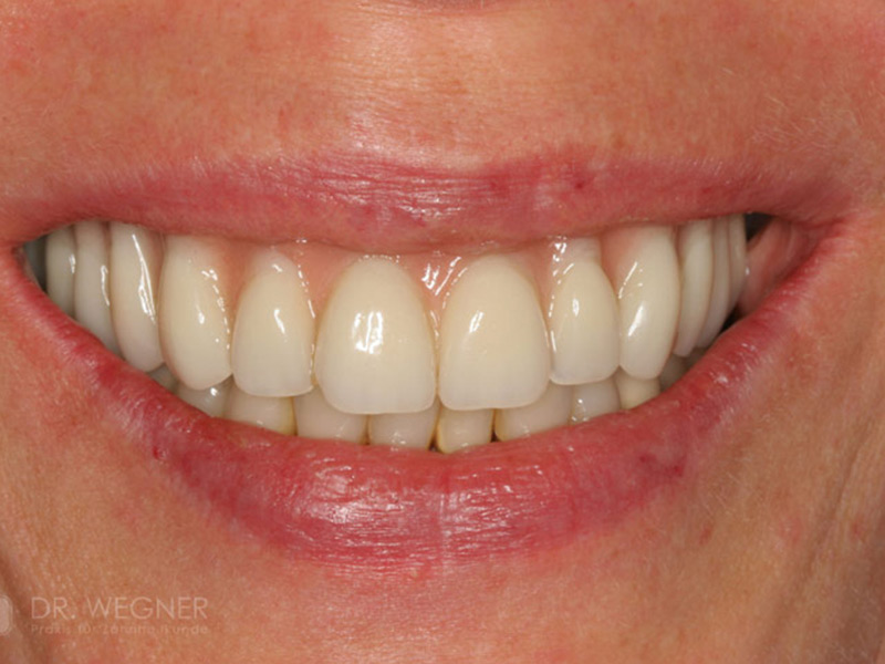 Komplexe Implantatbehandlung