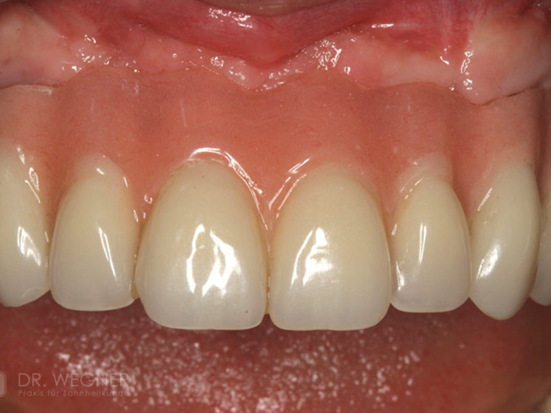 Komplexe Implantatbehandlung