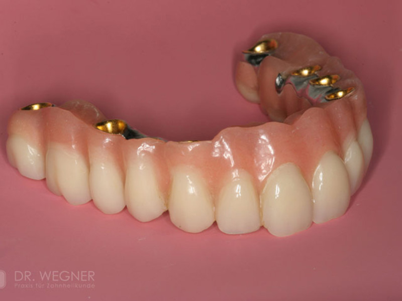Komplexe Implantatbehandlung
