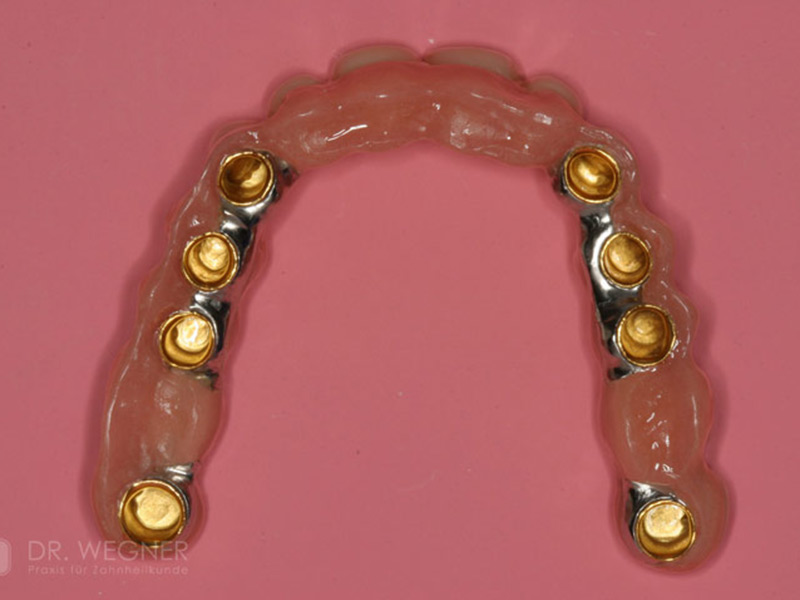 Komplexe Implantatbehandlung