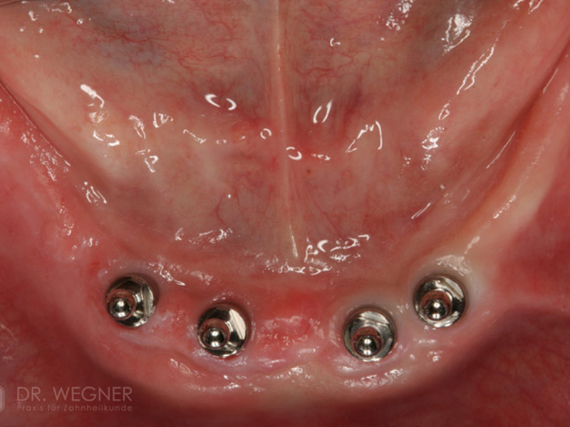 Verankerung Totalprothese