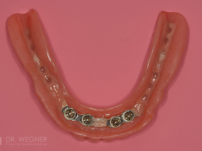 Verankerung Totalprothese